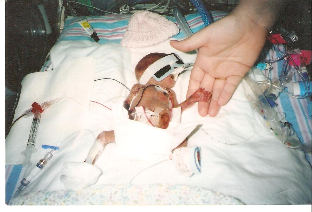 A few days after birth, Emily’s little hand was no bigger than her mom’s finger. 